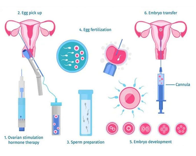 In vitro fertilization ivf-new